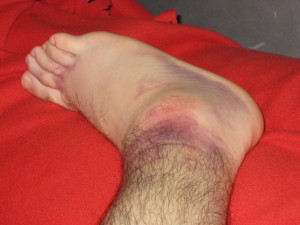 Ankle swell and internal bleeding
